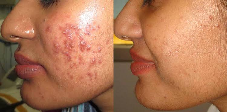 Acne & Pimple Treatment