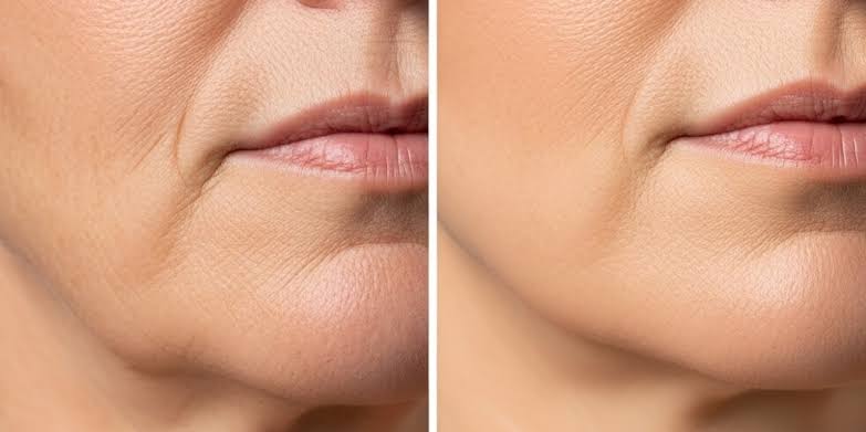 Anti-Aging & Skin Tightening