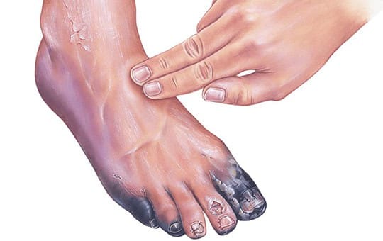Gangrene