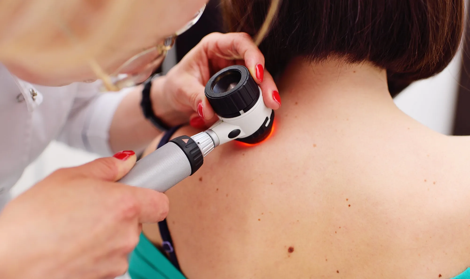 Mole & Skin Cancer Checks