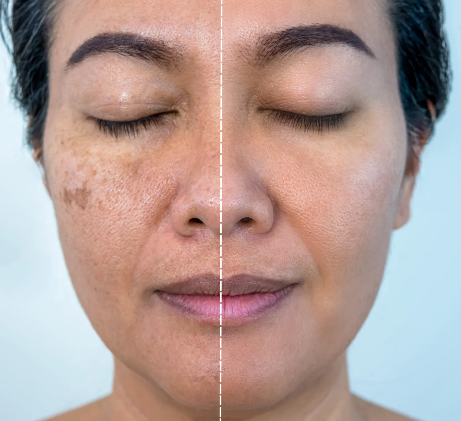 Pigmentation & Dark Spot Treatment