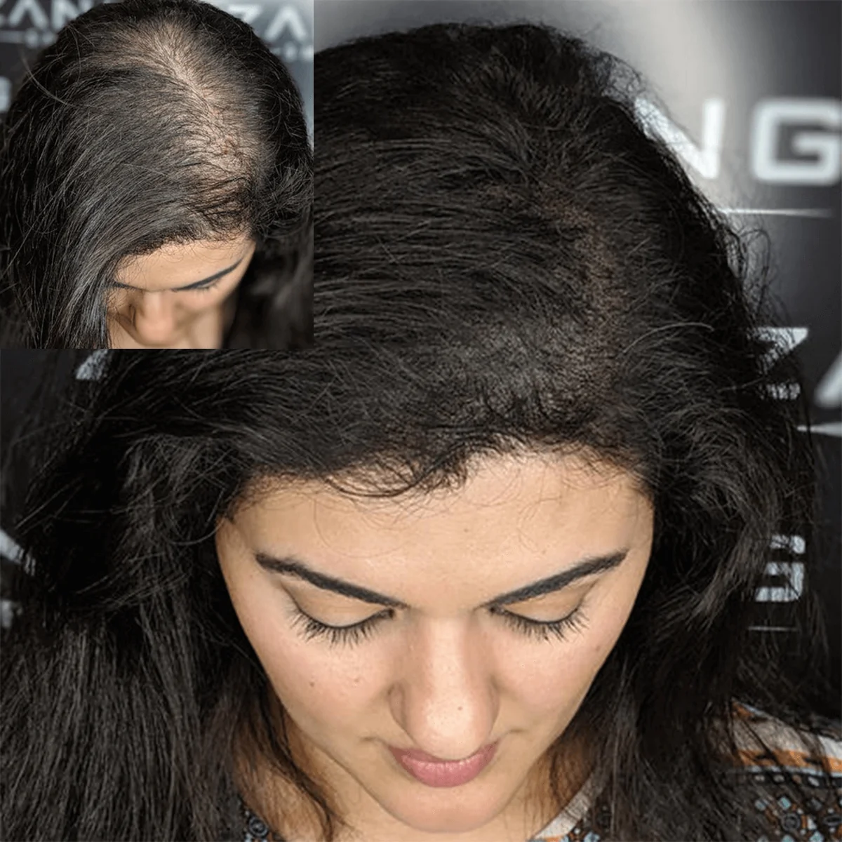Scalp Micropigmentation