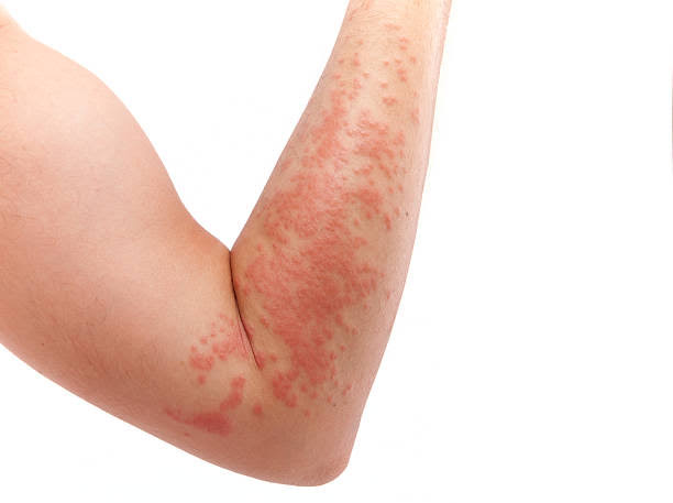 Skin Allergy Treatment