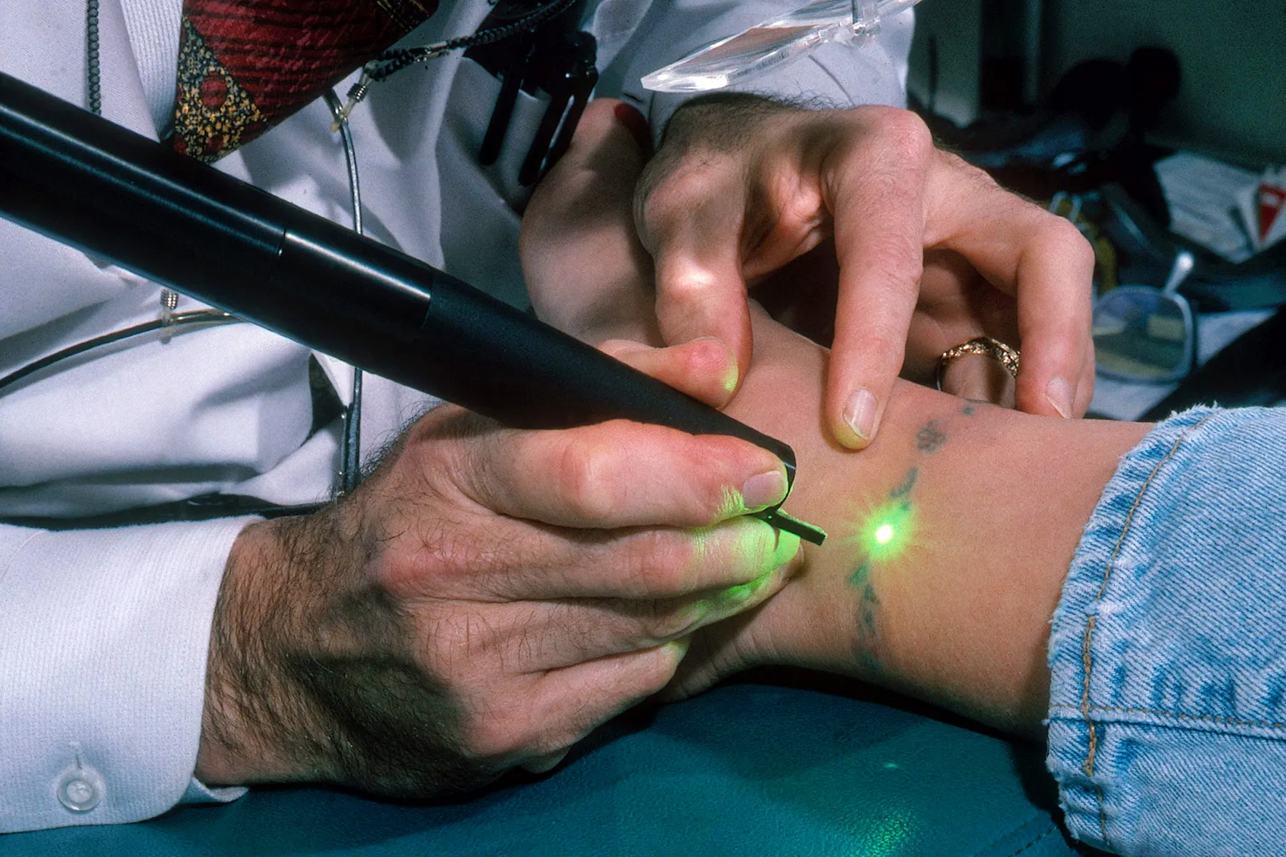 Tattoo removal