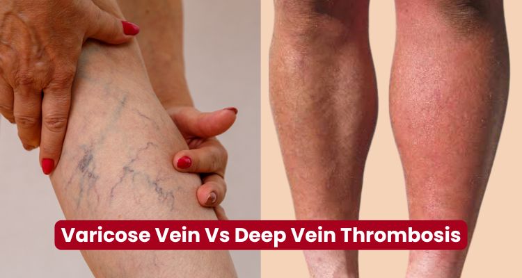 Varicose Veins & DVT Care
