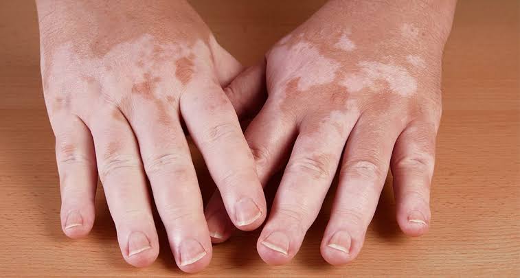 Vitiligo Treatment