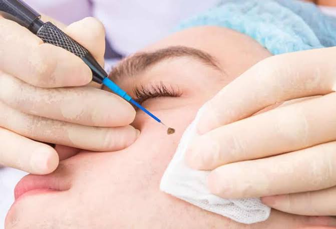 Wart & Mole Removal