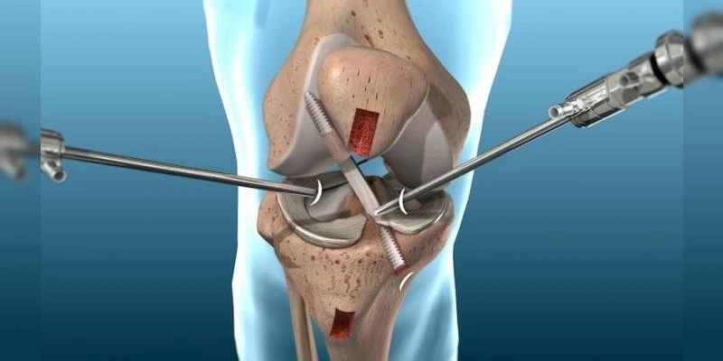 Arthroscopy