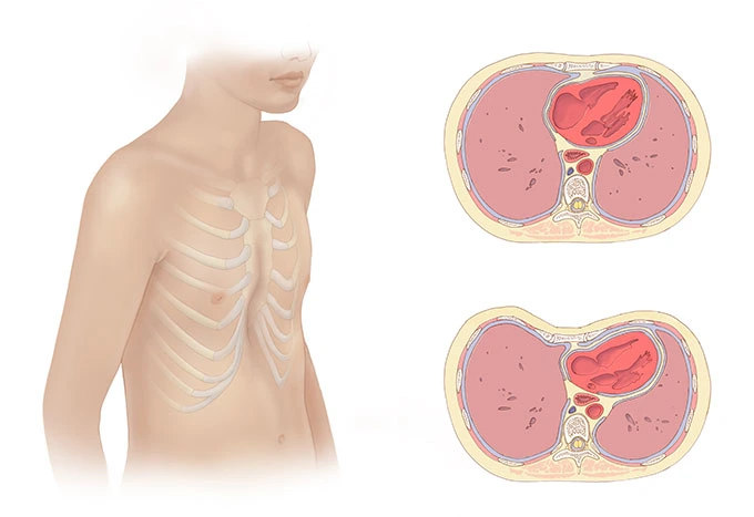 Chest Wall Surgery