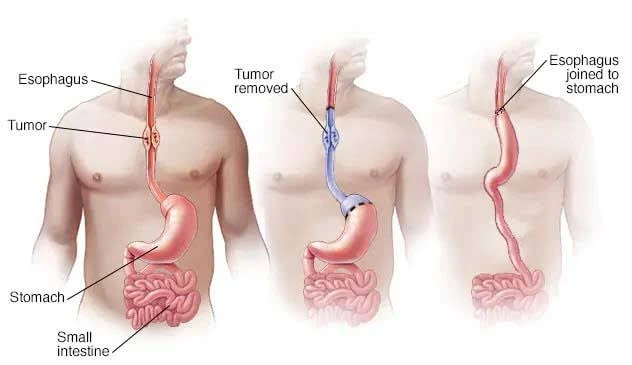 Esophageal Surgery