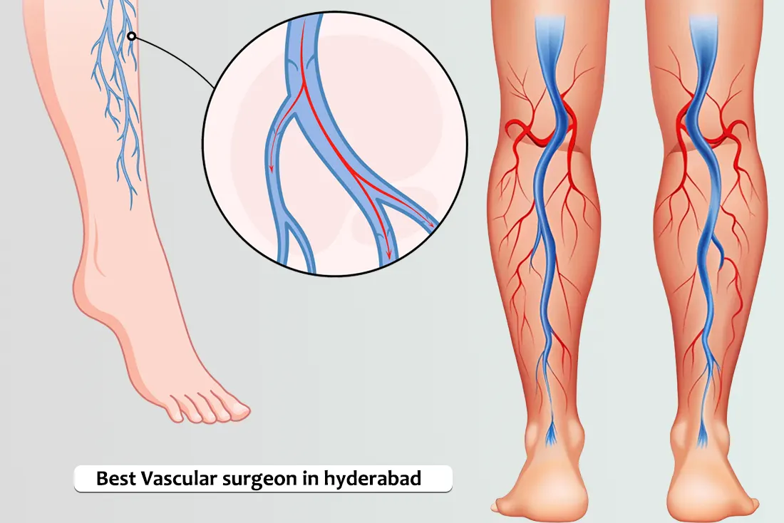 Vascular Surgery in Kukatpally | Chiranjeevi Hospitals