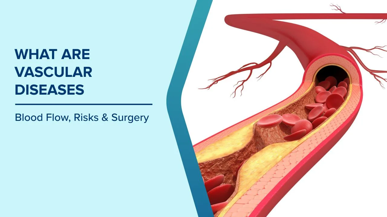 Preparing for Vascular Surgery: Everything You Need to Know Before Your Procedure